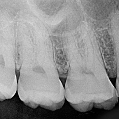 RADIOGRAFIA PERIAPICAL (1)