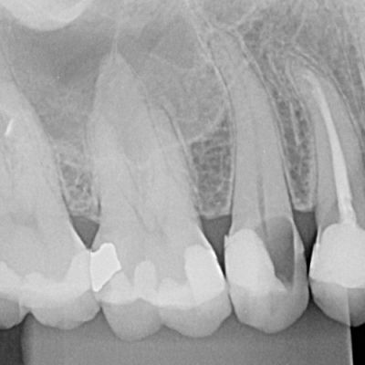 RADIOGRAFIA PERIAPICAL (2)